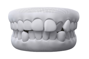 crooked teeth