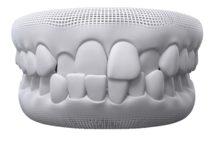 cross bite