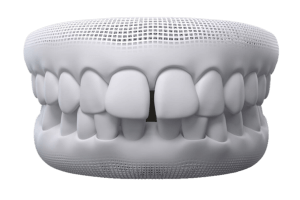 gap bite