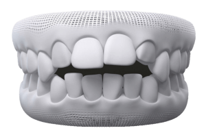 open bite